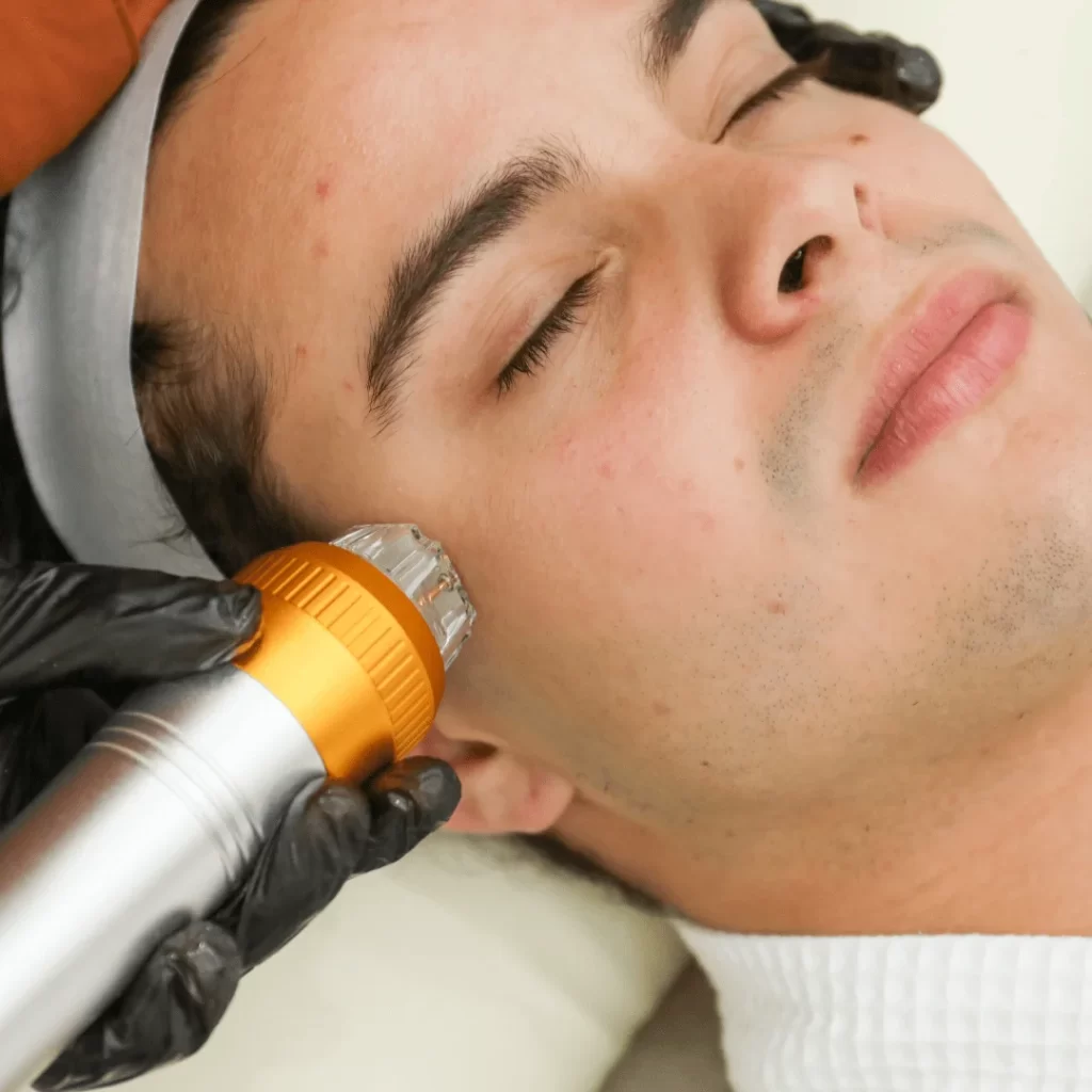 Microagujas de Oro con Radiofrecuencia Fraccionada